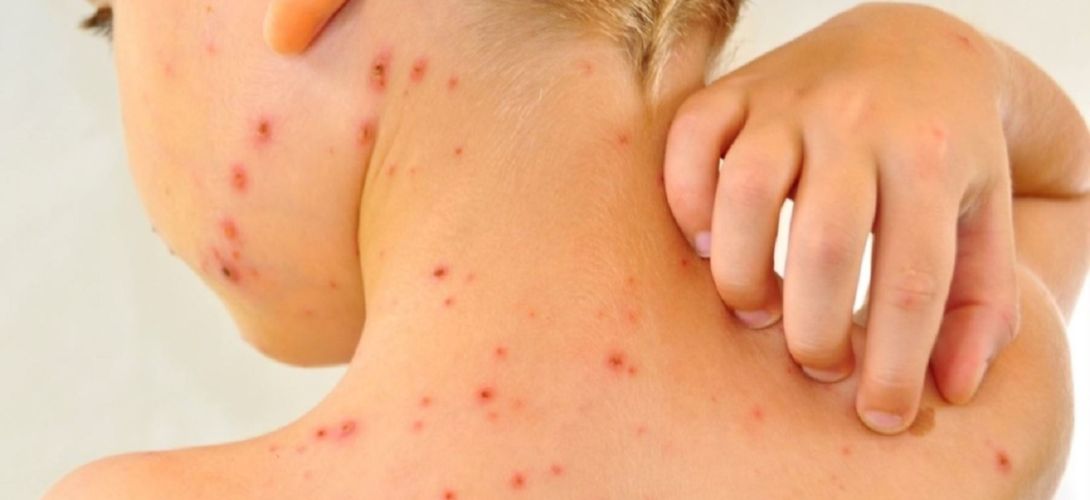 Activan vigilancia epidemiológica