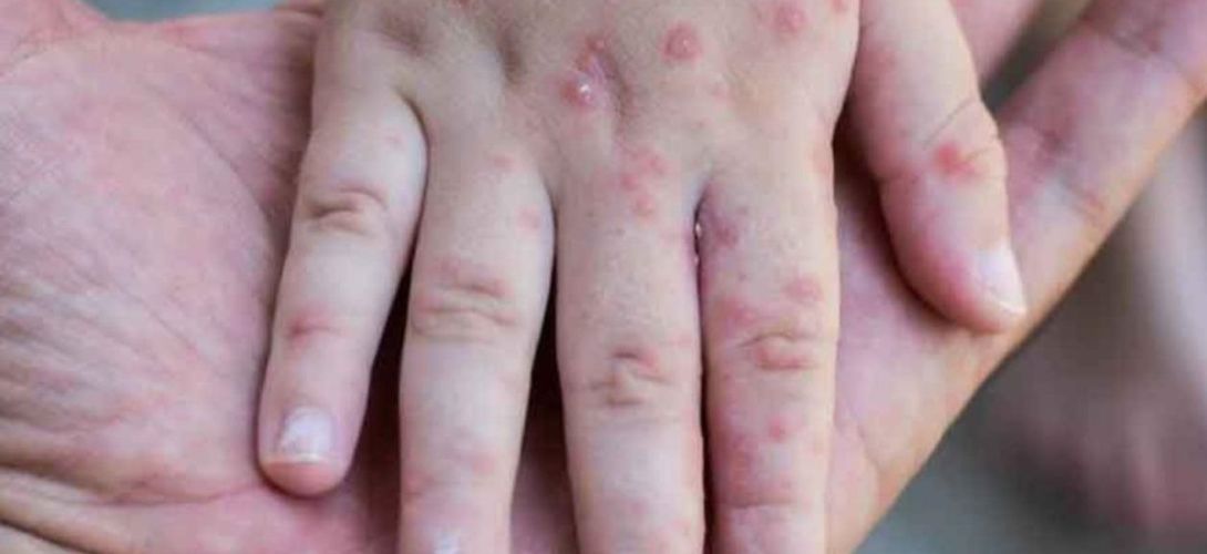 Descartan casos de sarampión en Coatza